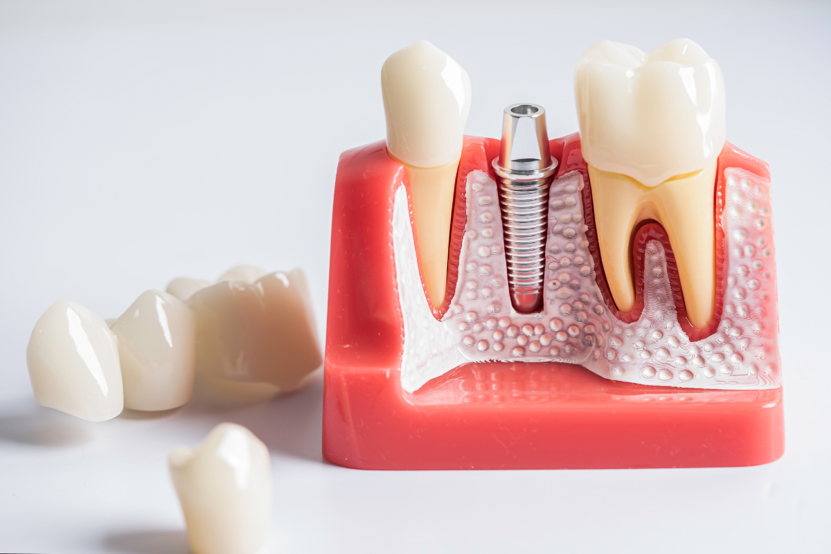 Protect Your Jawbone and Natural Smile