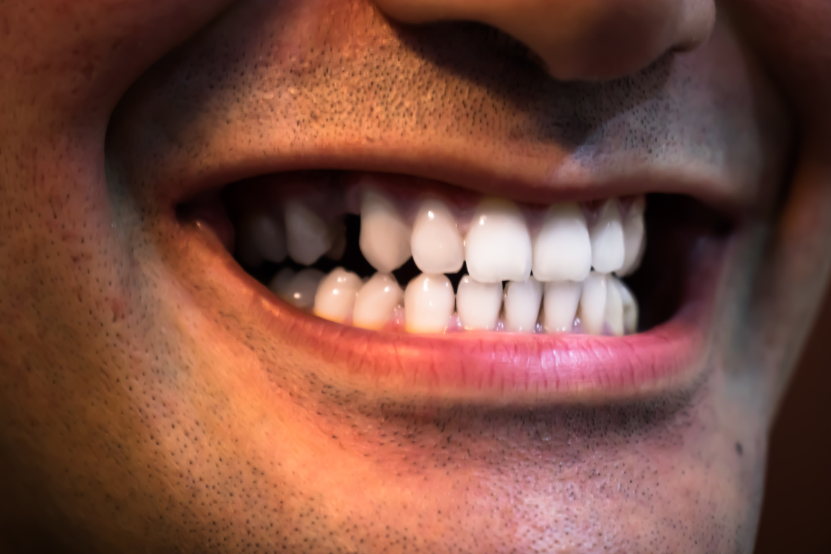 professional teeth whitening procedure