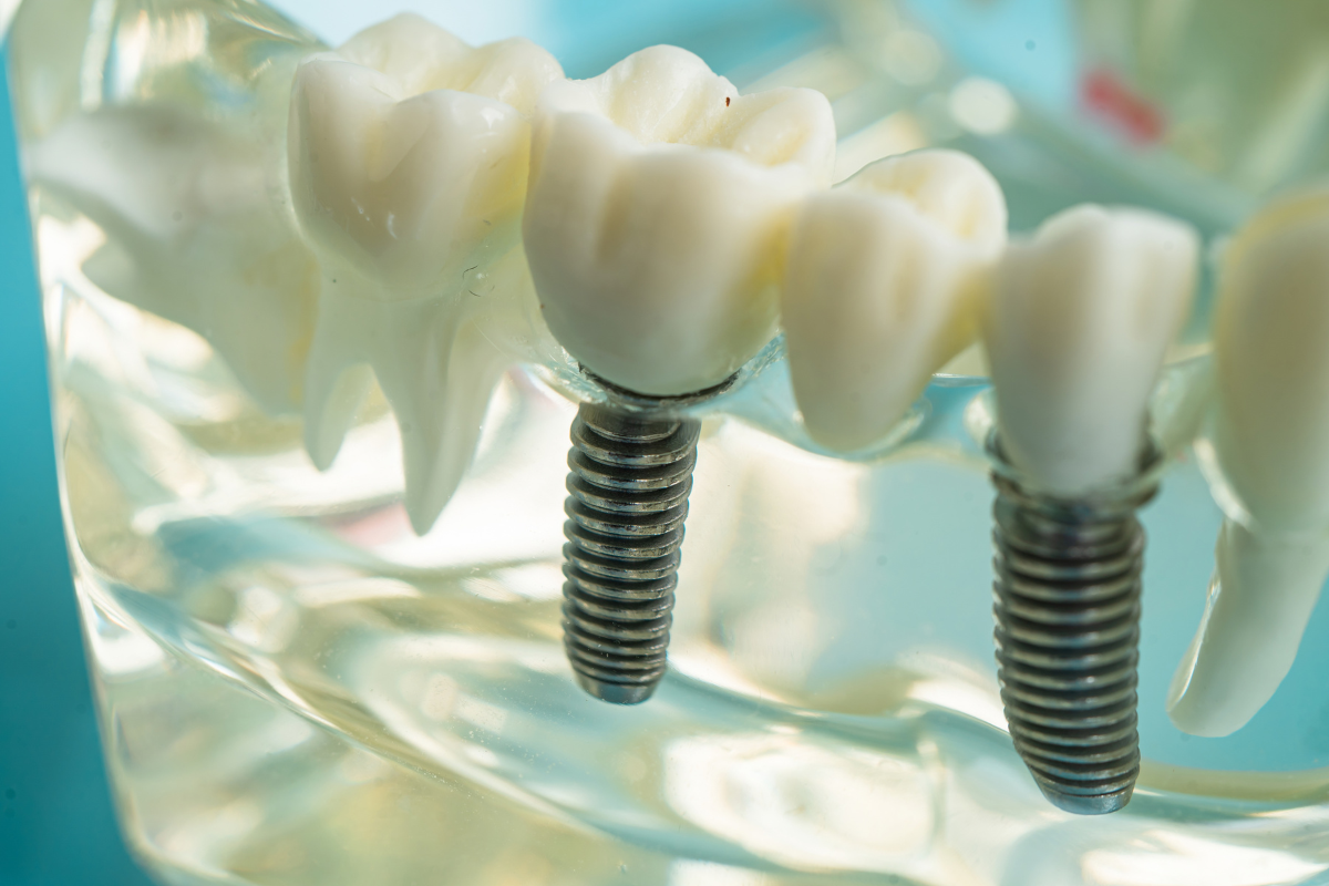 Modern Tooth Replacement